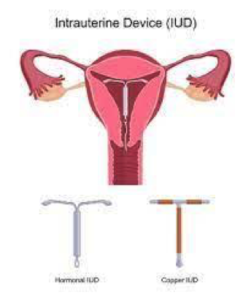 what are contraceptive methods IUD